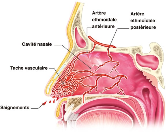 Saignements de nez - Troubles du nez, de la gorge et de l'oreille