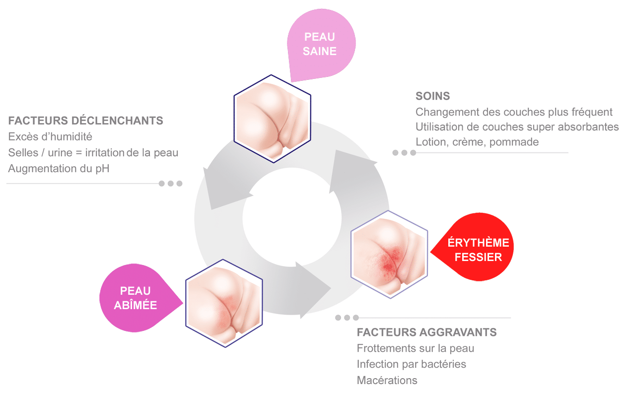 Comment traiter l'érythème fessier ? | Coalgan Gamme