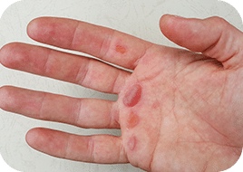 Pansements cicatrisants pour ampoules ouvertes