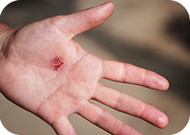 Soigner une ampoule ouverte avec Coalgan POUDRE