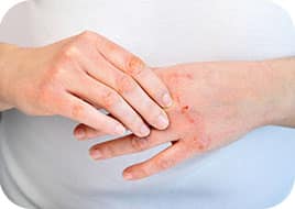 Froid et plaies superficielles, les soigner avec Coalgan POUDRE