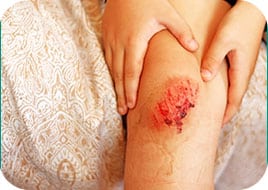 Soigner une plaie superficielle avec Coalgan® POUDRE