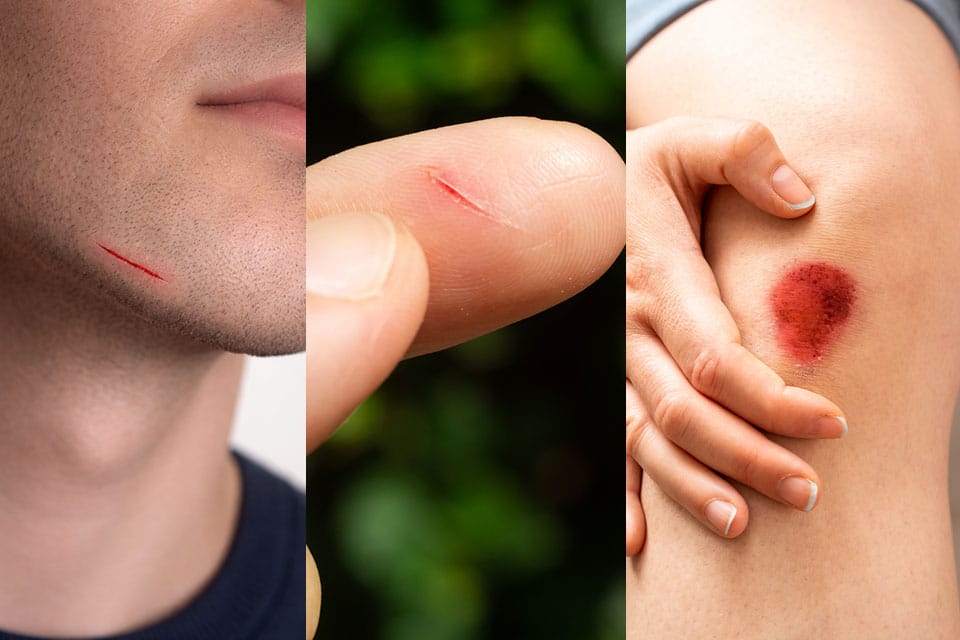 Soigner les petits saignements avec Coalgan GAMME