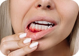 Arrêter un saignement de gencives avec Coalgan COMPRESSE