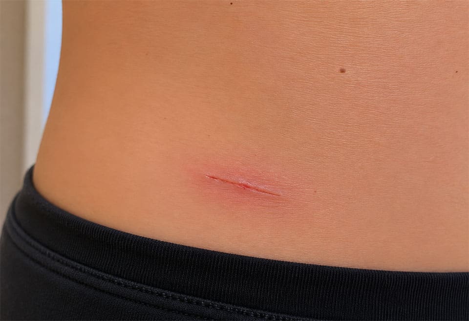 Les frottements retardent la cicatrisation des plaies superficielles